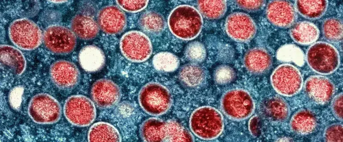 Mpox Outbreak India reports its first suspected mpox case, isolating the patient as concerns grow over the global mpox outbreak.